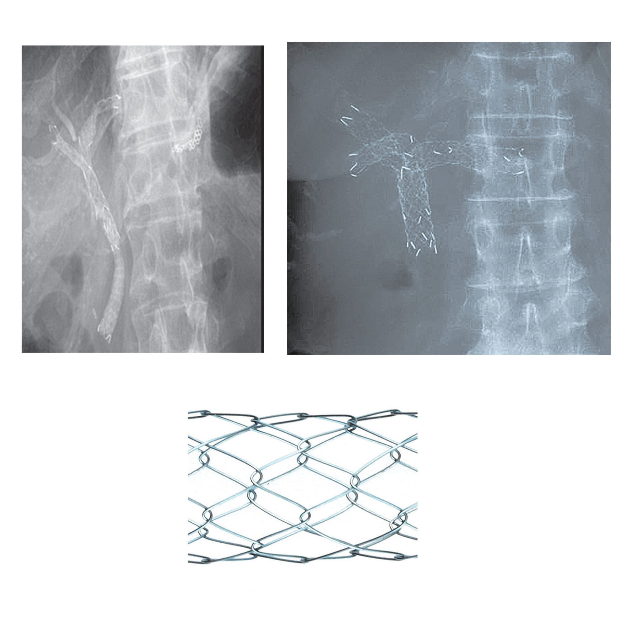 LCD Biliary Stent - Healthcare21