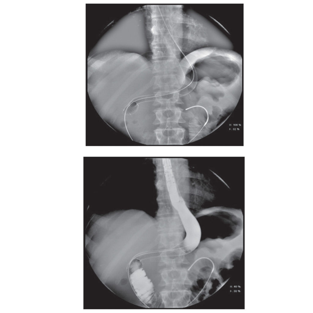 Mega Oesophageal Stent – Healthcare21