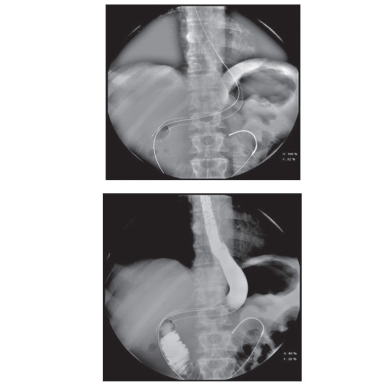 Mega Oesophageal Stent Healthcare21